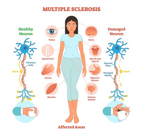 multiple sclerosis symptoms in spanish.